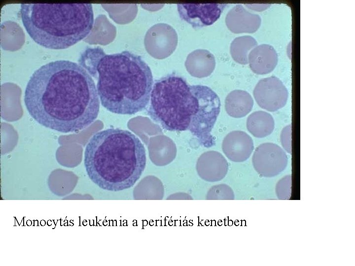 Monocytás leukémia a perifériás kenetben 