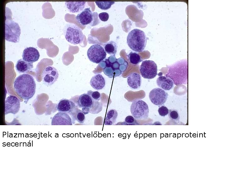 Plazmasejtek a csontvelőben: egy éppen paraproteint secernál 