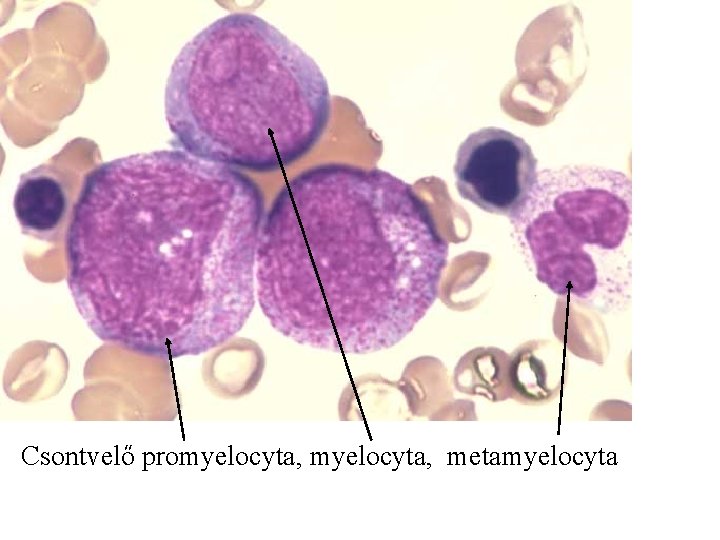 Csontvelő promyelocyta, metamyelocyta 