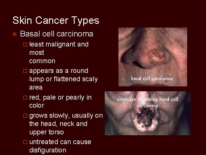 Skin Cancer Types n Basal cell carcinoma ¨ least malignant and most common ¨