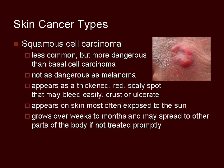 Skin Cancer Types n Squamous cell carcinoma ¨ less common, but more dangerous than