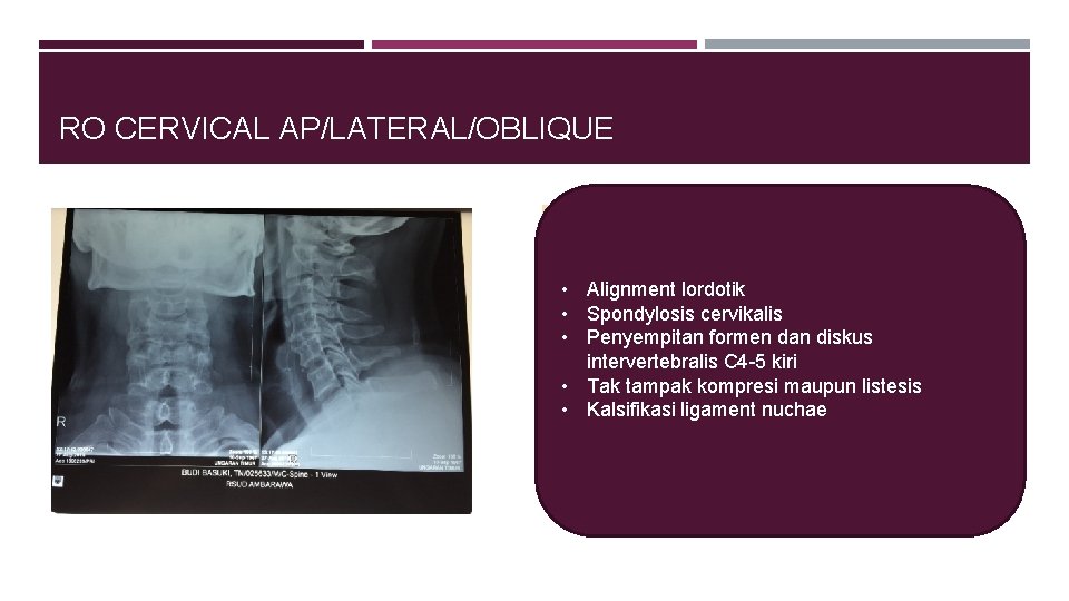 RO CERVICAL AP/LATERAL/OBLIQUE • Alignment lordotik • Spondylosis cervikalis • Penyempitan formen dan diskus