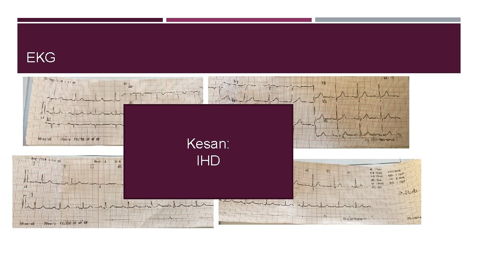 EKG Kesan: IHD 