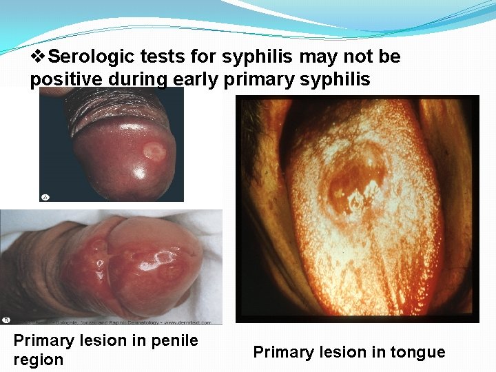 v. Serologic tests for syphilis may not be positive during early primary syphilis Primary
