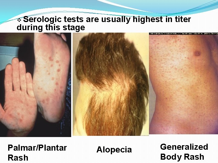 v Serologic tests are usually highest in titer during this stage Palmar/Plantar Rash Alopecia