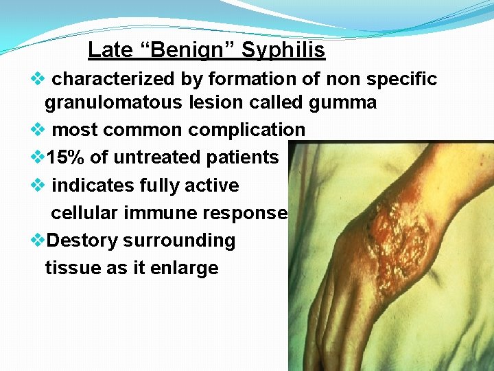 Late “Benign” Syphilis v characterized by formation of non specific granulomatous lesion called gumma