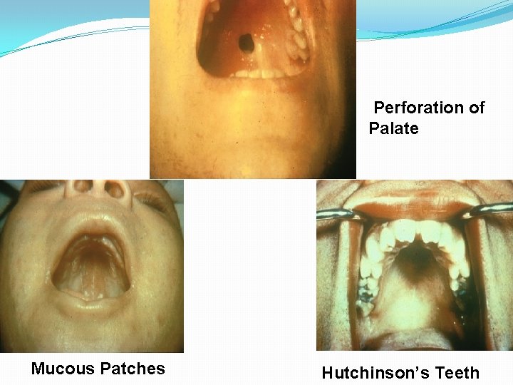 Perforation of Palate Mucous Patches Hutchinson’s Teeth 