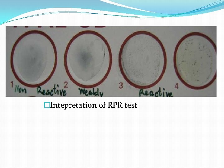 �Intepretation of RPR test 