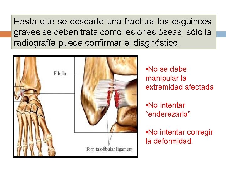 Hasta que se descarte una fractura los esguinces graves se deben trata como lesiones