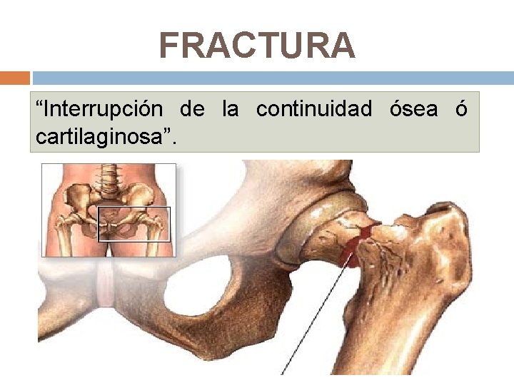 FRACTURA “Interrupción de la continuidad ósea ó cartilaginosa”. 