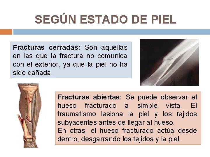 SEGÚN ESTADO DE PIEL Fracturas cerradas: Son aquellas en las que la fractura no