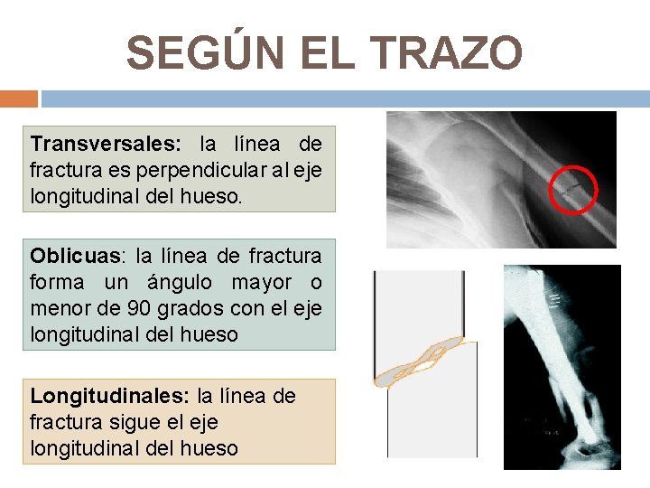 SEGÚN EL TRAZO Transversales: la línea de fractura es perpendicular al eje longitudinal del