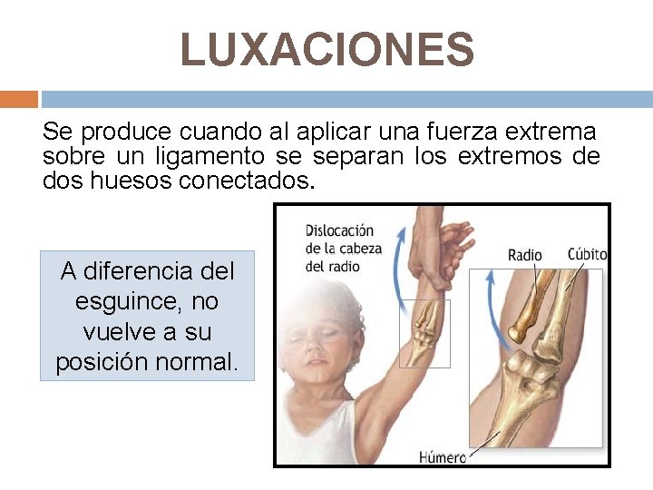 LUXACIONES Se produce cuando al aplicar una fuerza extrema sobre un ligamento se separan