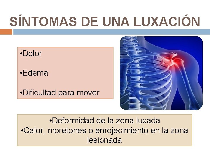 SÍNTOMAS DE UNA LUXACIÓN • Dolor • Edema • Dificultad para mover • Deformidad