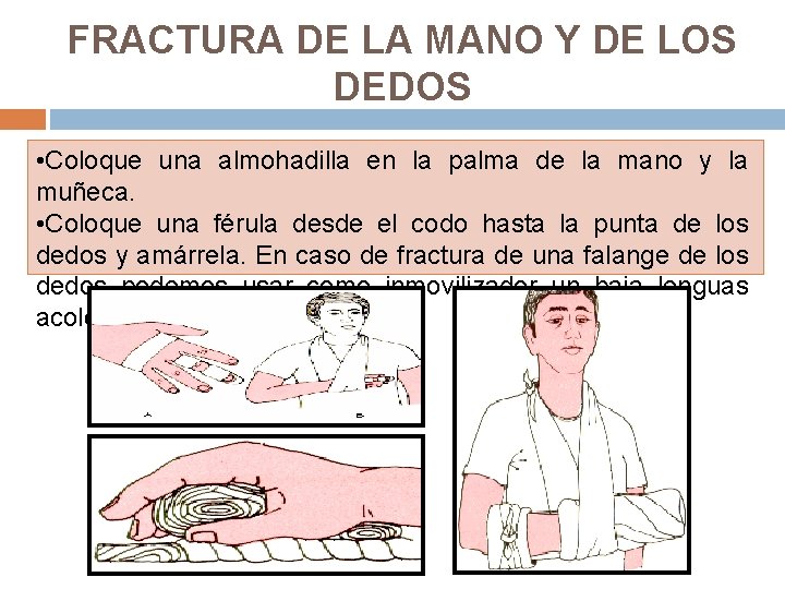 FRACTURA DE LA MANO Y DE LOS DEDOS • Coloque una almohadilla en la