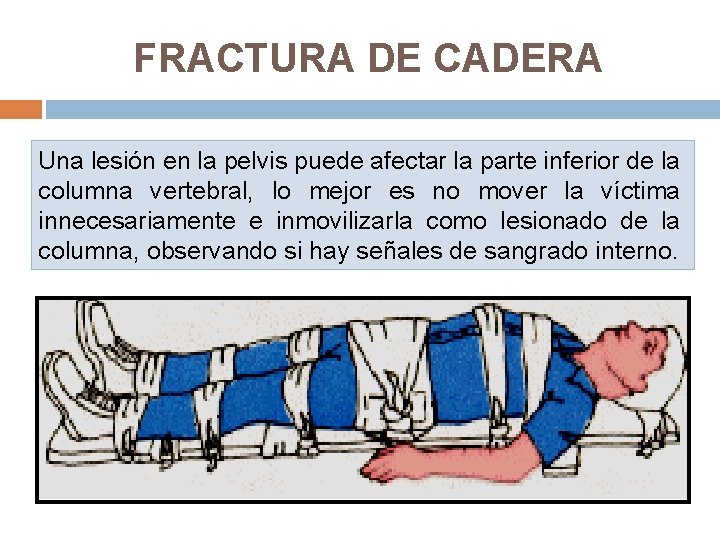 FRACTURA DE CADERA Una lesión en la pelvis puede afectar la parte inferior de