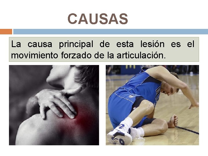 CAUSAS La causa principal de esta lesión es el movimiento forzado de la articulación.