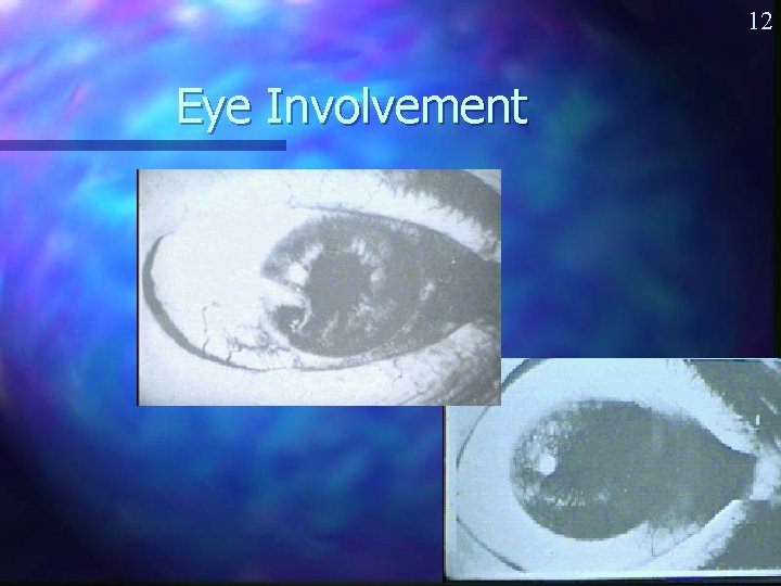 12 Eye Involvement 1/19/2022 