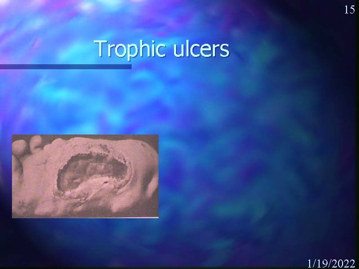 15 Trophic ulcers 1/19/2022 