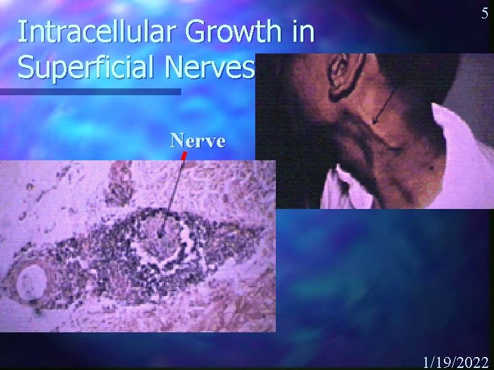 Intracellular Growth in Superficial Nerves 5 Nerve 1/19/2022 