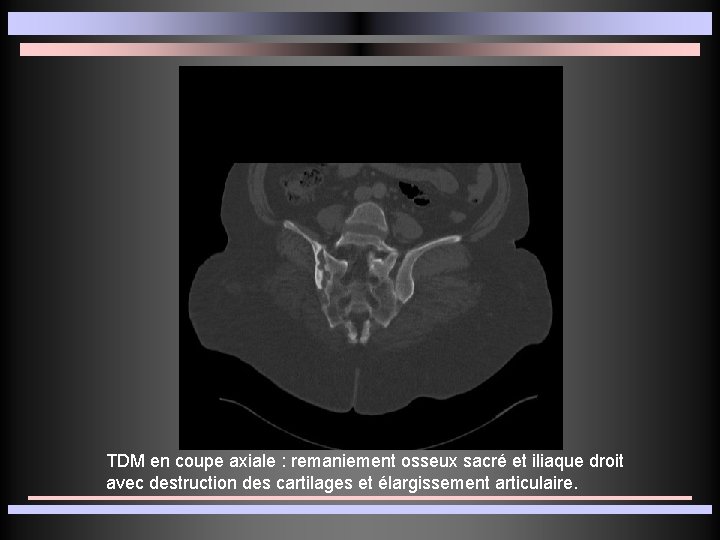 TDM en coupe axiale : remaniement osseux sacré et iliaque droit avec destruction des