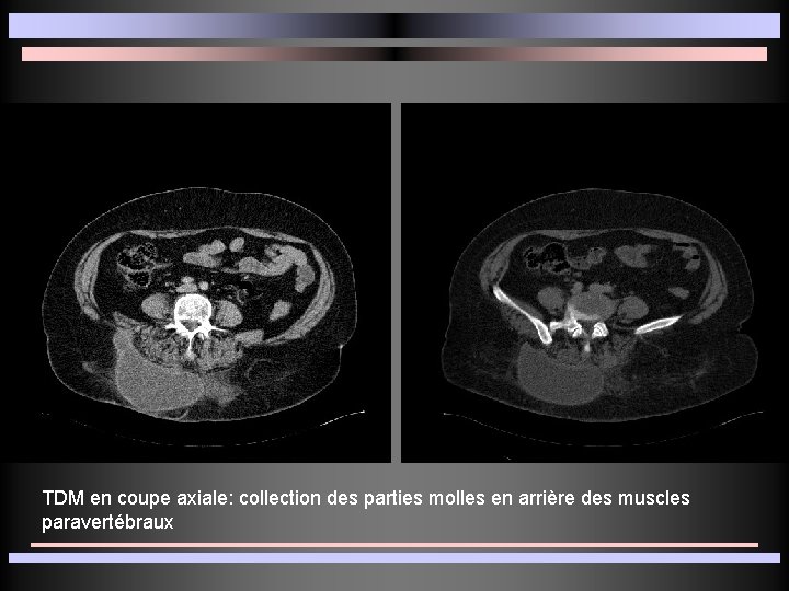 TDM en coupe axiale: collection des parties molles en arrière des muscles paravertébraux 