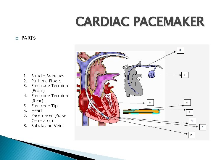 CARDIAC PACEMAKER � PARTS 1. Bundle Branches 2. Purkinje Fibers 3. Electrode Terminal (Front)