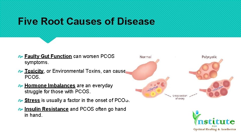 Five Root Causes of Disease Faulty Gut Function can worsen PCOS symptoms. Toxicity, or