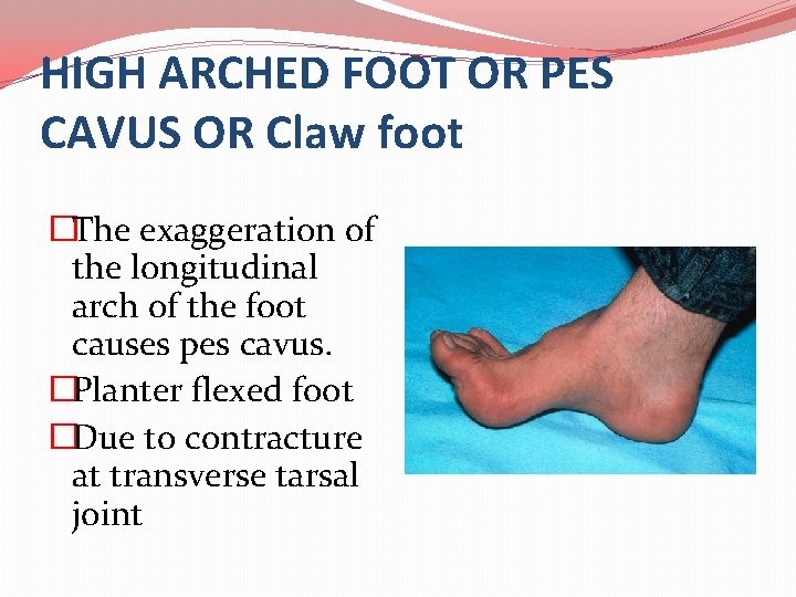 HIGH ARCHED FOOT OR PES CAVUS OR Claw foot �The exaggeration of the longitudinal