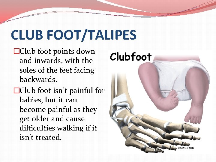 CLUB FOOT/TALIPES �Club foot points down and inwards, with the soles of the feet