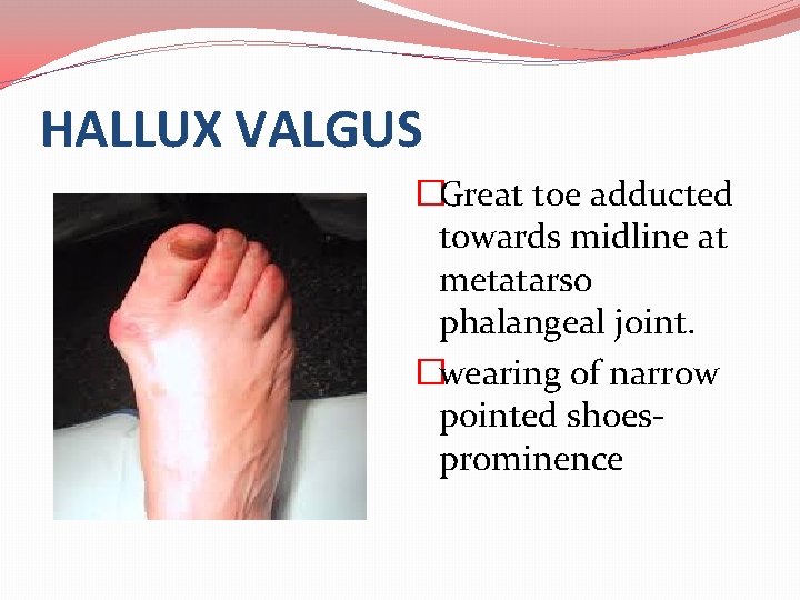 HALLUX VALGUS �Great toe adducted towards midline at metatarso phalangeal joint. �wearing of narrow