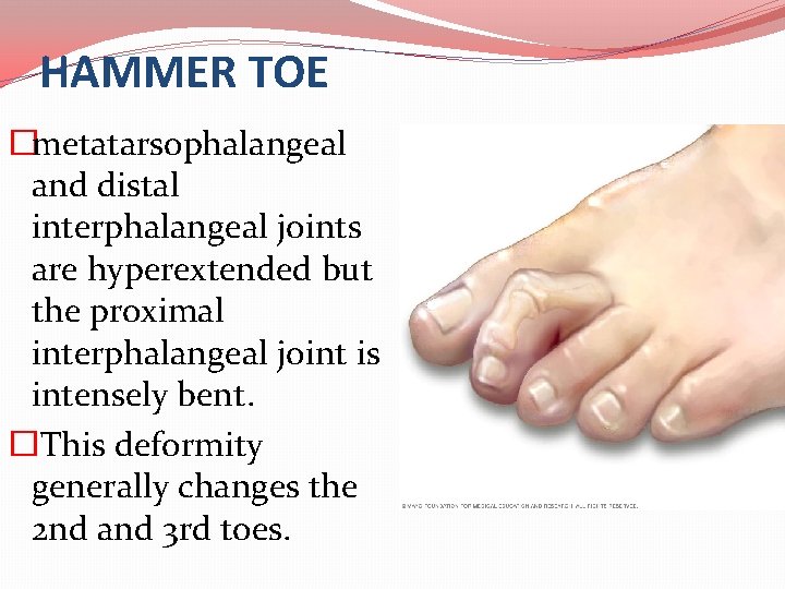 HAMMER TOE �metatarsophalangeal and distal interphalangeal joints are hyperextended but the proximal interphalangeal joint