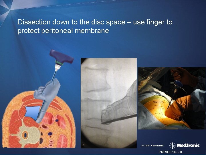 Dissection down to the disc space – use finger to protect peritoneal membrane 15