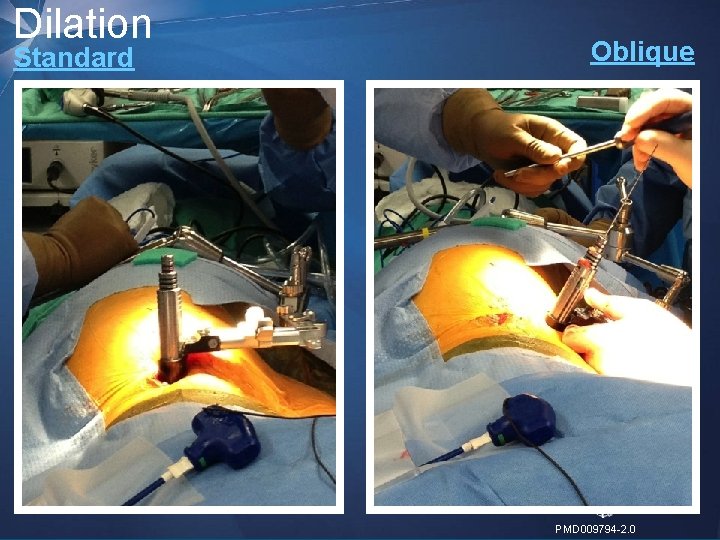 Dilation Oblique Standard 17 | MDT Confidential PMD 009794 -2. 0 Dilation Oblique Standard 17 | MDT Confidential PMD 009794 -2. 0