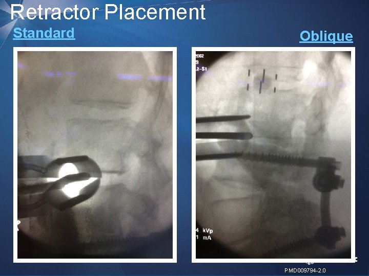 Retractor Placement Standard Oblique 18 | MDT Confidential PMD 009794 -2. 0 