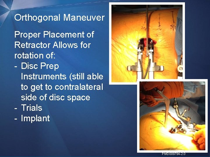 Orthogonal Maneuver Proper Placement of Retractor Allows for rotation of: - Disc Prep Instruments