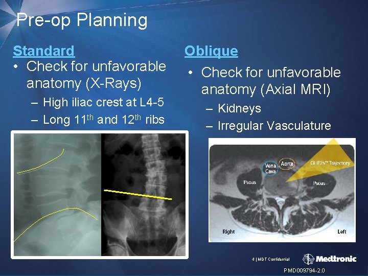 Pre-op Planning Standard • Check for unfavorable anatomy (X-Rays) – High iliac crest at