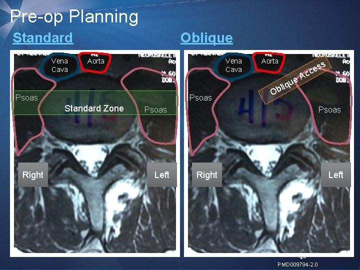 Pre-op Planning Standard Vena Cava Oblique Vena Cava Aorta Psoas Standard Zone Right Aorta