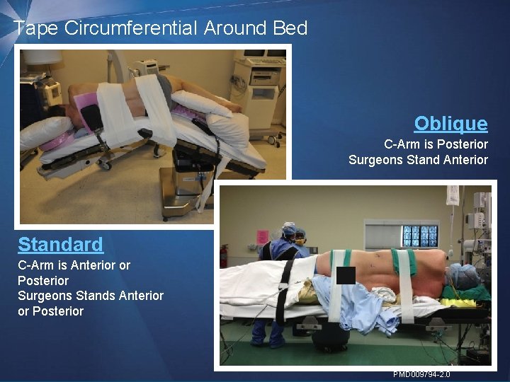 Tape Circumferential Around Bed Oblique C-Arm is Posterior Surgeons Stand Anterior Standard C-Arm is