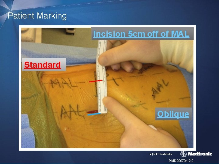 Patient Marking Incision 5 cm off of MAL Standard Oblique 9 | MDT Confidential