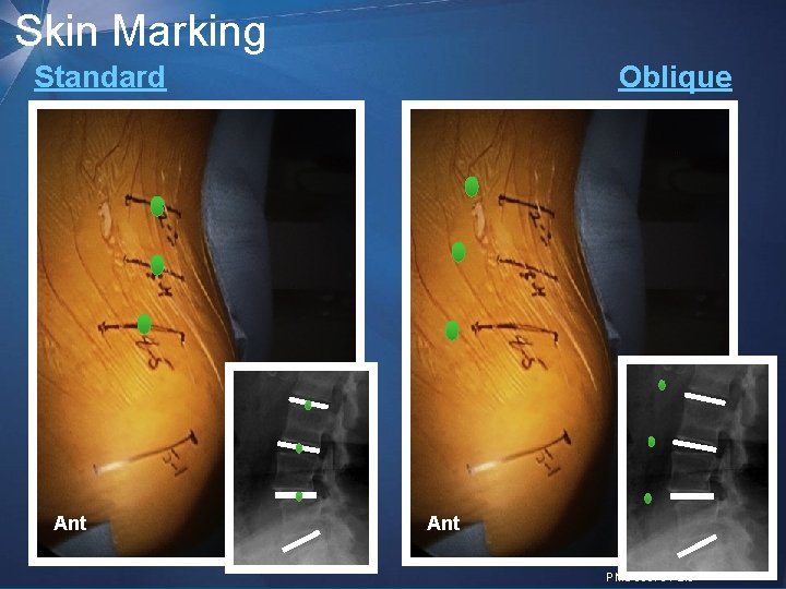 Skin Marking Standard Ant Oblique Post Ant Post 10 | MDT Confidential PMD 009794