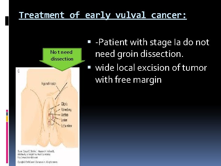 Treatment of early vulval cancer: No t need dissection -Patient with stage Ia do