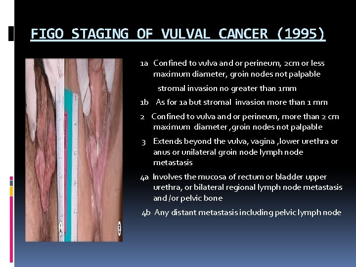 FIGO STAGING OF VULVAL CANCER (1995) 1 a Confined to vulva and or perineum,