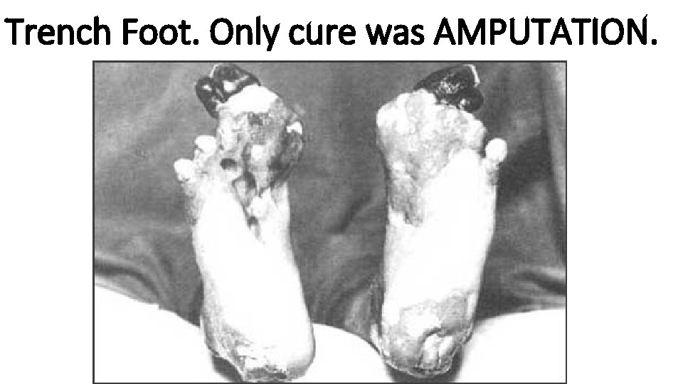 Trench Foot. Only cure was AMPUTATION. 