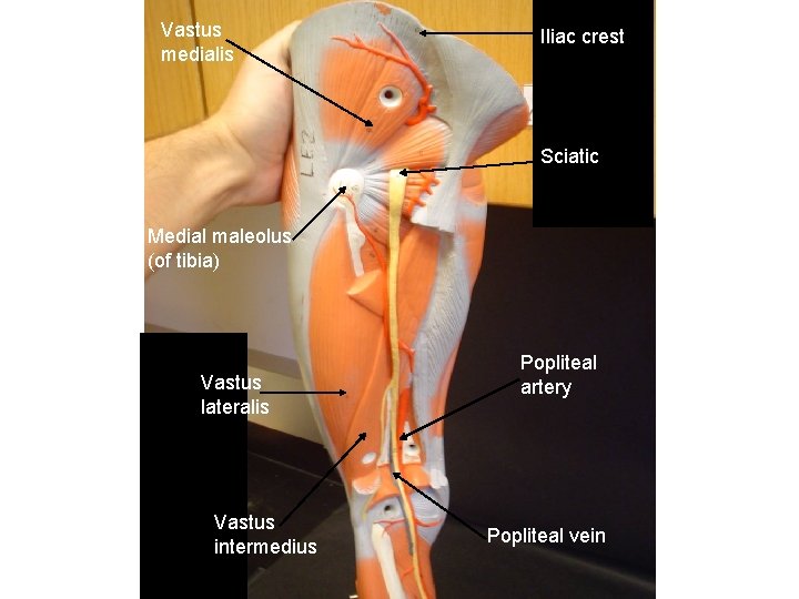 Vastus medialis Iliac crest Sciatic Medial maleolus (of tibia) Vastus lateralis Vastus intermedius Popliteal