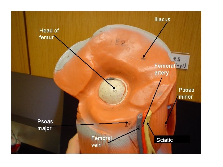 Iliacus Head of femur Femoral artery Psoas minor Psoas major Femoral vein Sciatic 