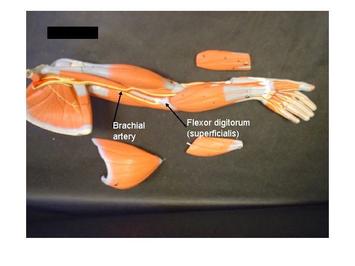 Brachial artery Flexor digitorum (superficialis) 