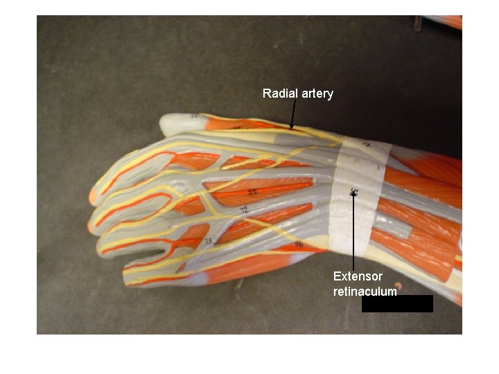 Radial artery Extensor retinaculum 