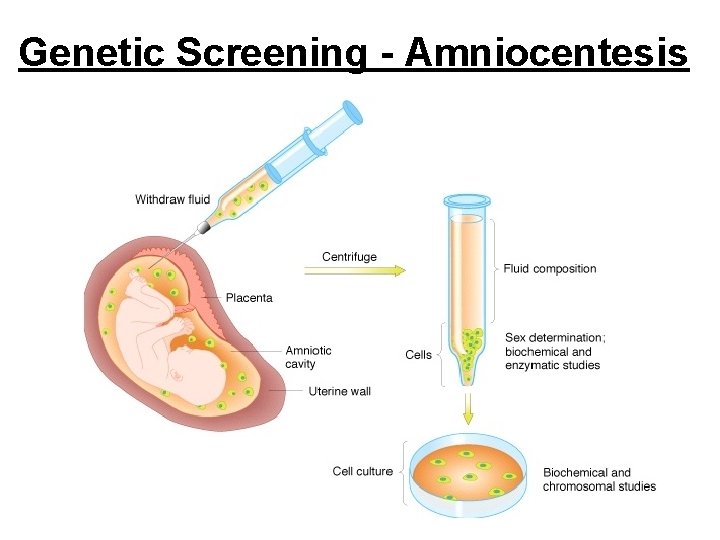 Genetic Screening - Amniocentesis Genetic Screening - Amniocentesis