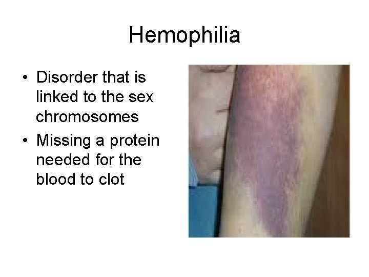 Hemophilia • Disorder that is linked to the sex chromosomes • Missing a protein Hemophilia • Disorder that is linked to the sex chromosomes • Missing a protein